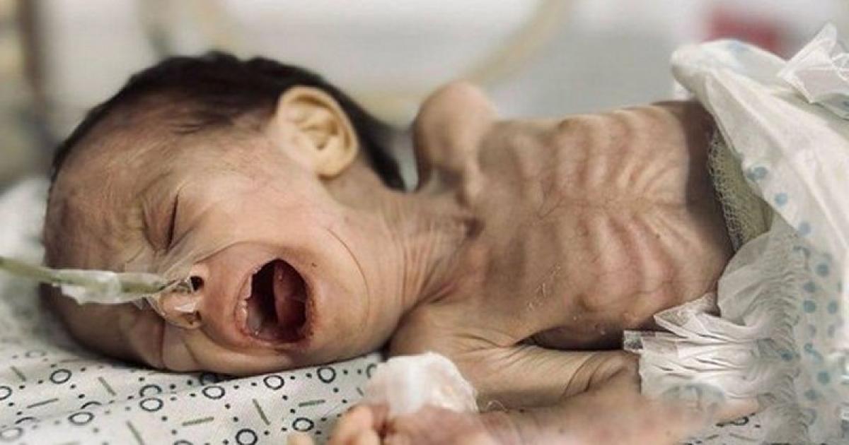 سياسة التجويع تفتك بـ 4 أطفال بمستشفى كمال عدوان خلال أسبوع | وكالة شمس نيوز الإخبارية - Shms News |
