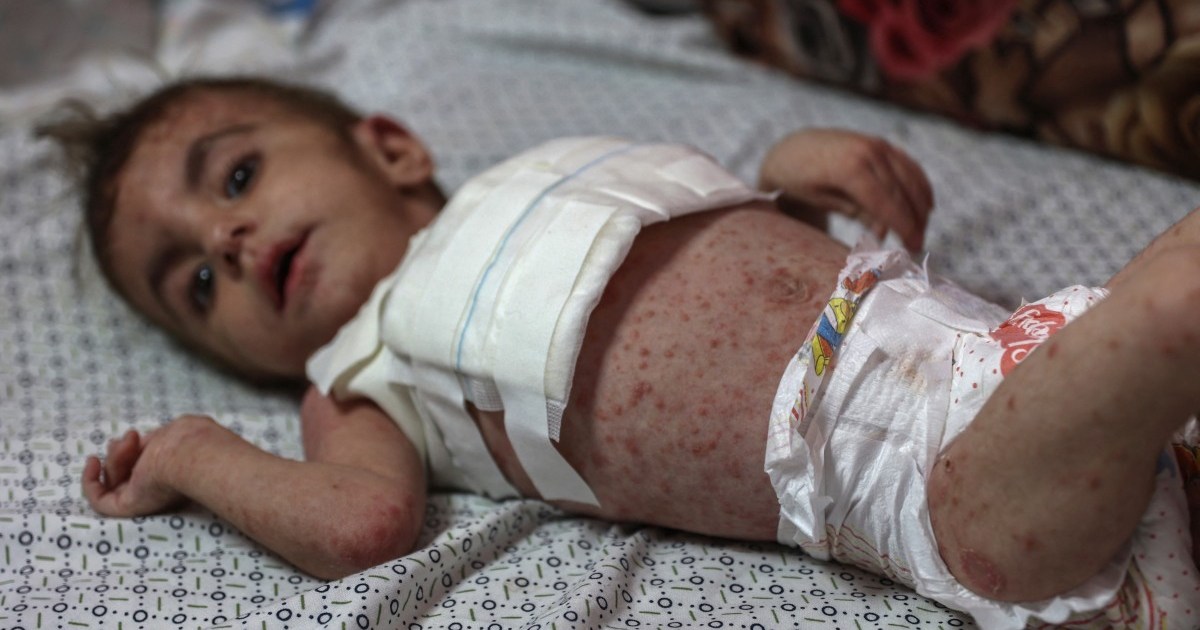 أمراض جلدية خطيرة تنتشر بين الأطفال في غزة | أخبار الصراع الإسرائيلي الفلسطيني