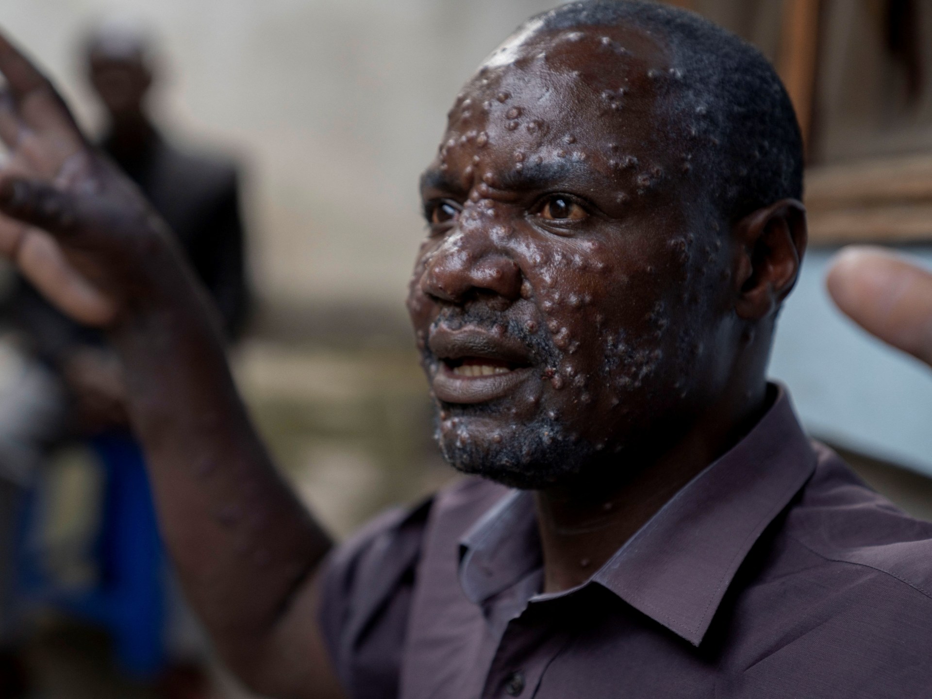 مركز السيطرة على الأمراض في أفريقيا يعلن حالة طوارئ صحية عامة بسبب عقار mpox | أخبار الصحة