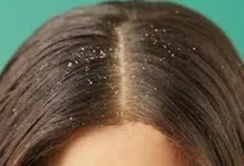 لماذا تظهر قشرة الشعر؟.. إليك الأسباب الخفية ونصائح لتجنبها