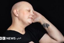 تساقط شعري بسبب العلاج الكيميائي لا يحدد هويتي، بل هو رمز لقوتي