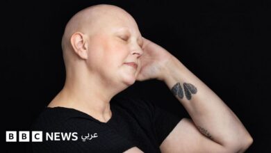 تساقط شعري بسبب العلاج الكيميائي لا يحدد هويتي، بل هو رمز لقوتي