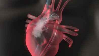 استبدال صمام أبهري دون جراحة قلب مفتوح